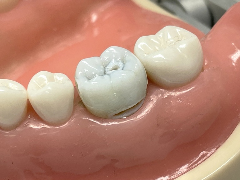 Educational Caries teeth in typodont