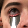 Reusable Sindt Spatula in use visualizing lower eye lid