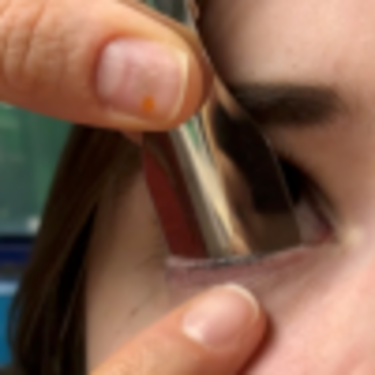 Reusable Sindt Spatula in use expressing meibomian gland from lower eye lid